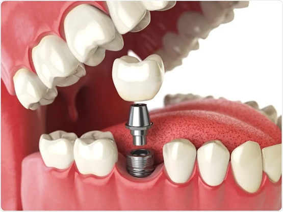 When Do We Use Dental Implants?