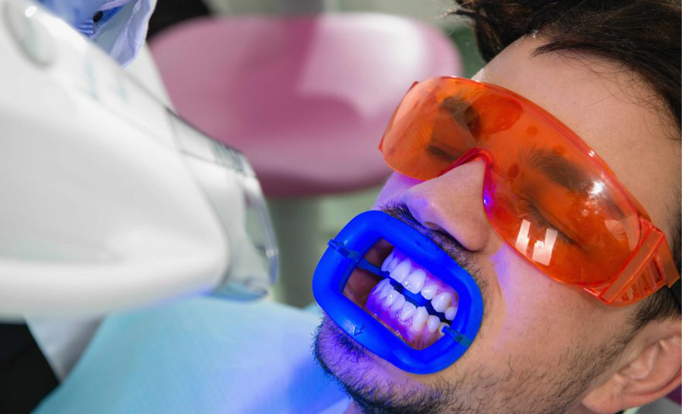 Advantages of Professional Teeth Whitening