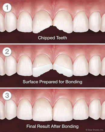 Dental Bonding