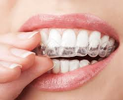 Invisalign