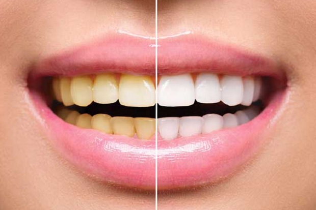 What is involved in teeth whitening