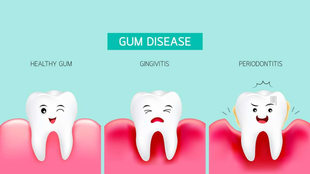 Periodontal Disease Stages