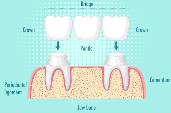 Dental Bridges