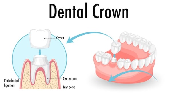 Dental Crowns