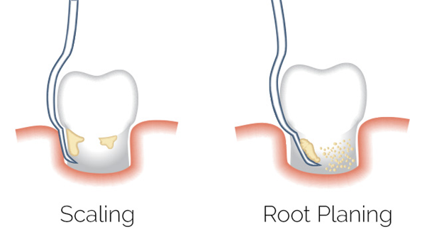 Scaling and Root Planing (aka: Deep Cleaning)